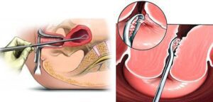 Хирургический аборт. Выскабливание матки - pharm-expert.info