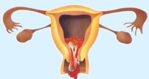 Неполный аборт после медикаментозного аборта pharm-expert.info